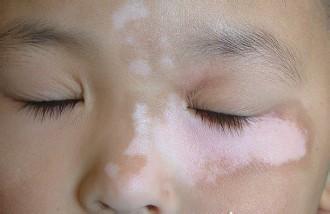 儿童脸上有白斑要如何治疗