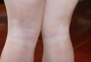 腿部白癜风常见症状有哪些